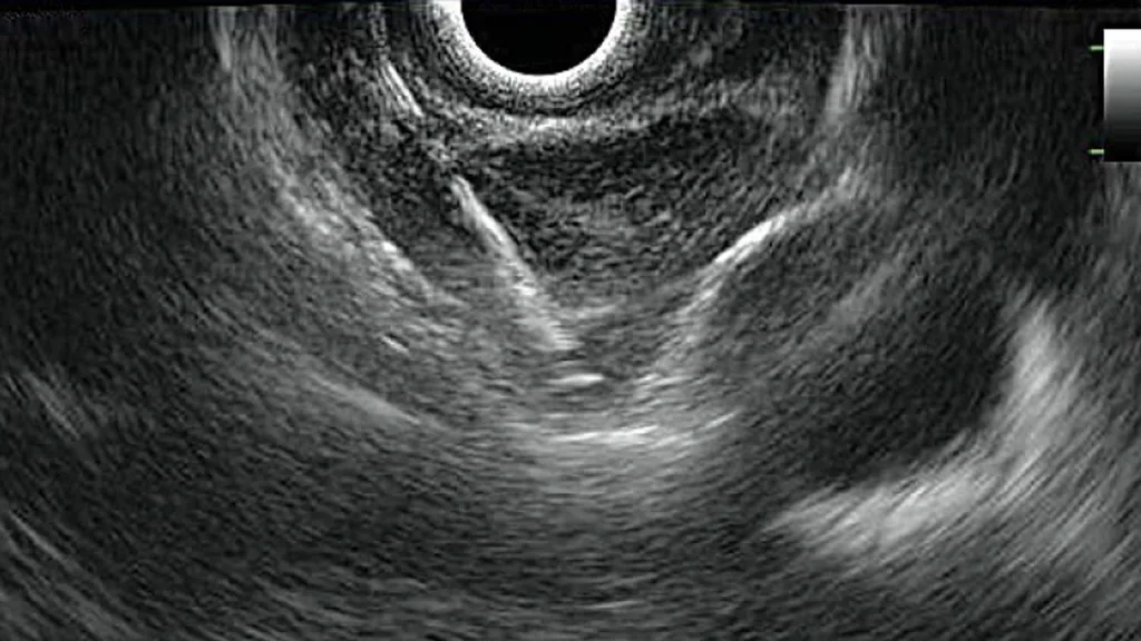 endoscopic ultrasound screen